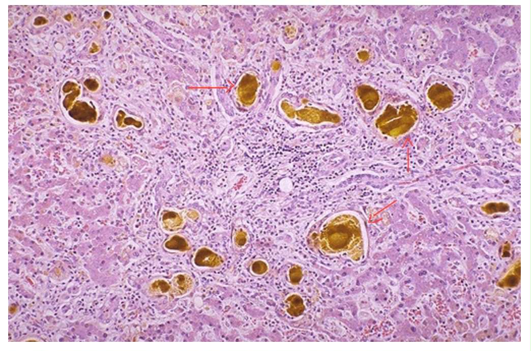 <p>Yellow-green globular material is seen within the small bile ductules. </p><ol><li><p>What is the name of the pigment?</p></li><li><p>This condition is a problem with excretion of bile or an obstruction to the flow of bile. The result would show the patient exhibiting jaundice.</p></li></ol><p></p>