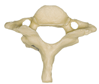 <p>Name this cervical vertebrae and its defining factor</p>