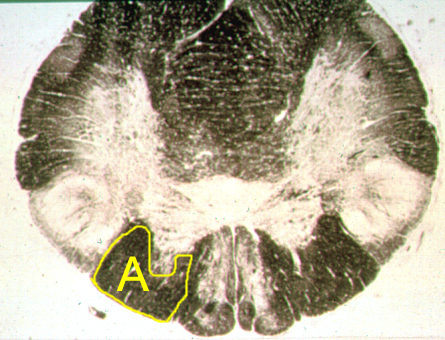 <p>Identify the structure indicated by the outline and letter "A".</p><p><span>A. Fasciculus cuneatus</span></p><p><span>B. Fasciculus gracilus</span></p><p><span>C. Spinal trigeminal tract</span></p><p><span>D. Medial lemniscus</span></p><p><span>E. Pyramids</span></p><p></p>