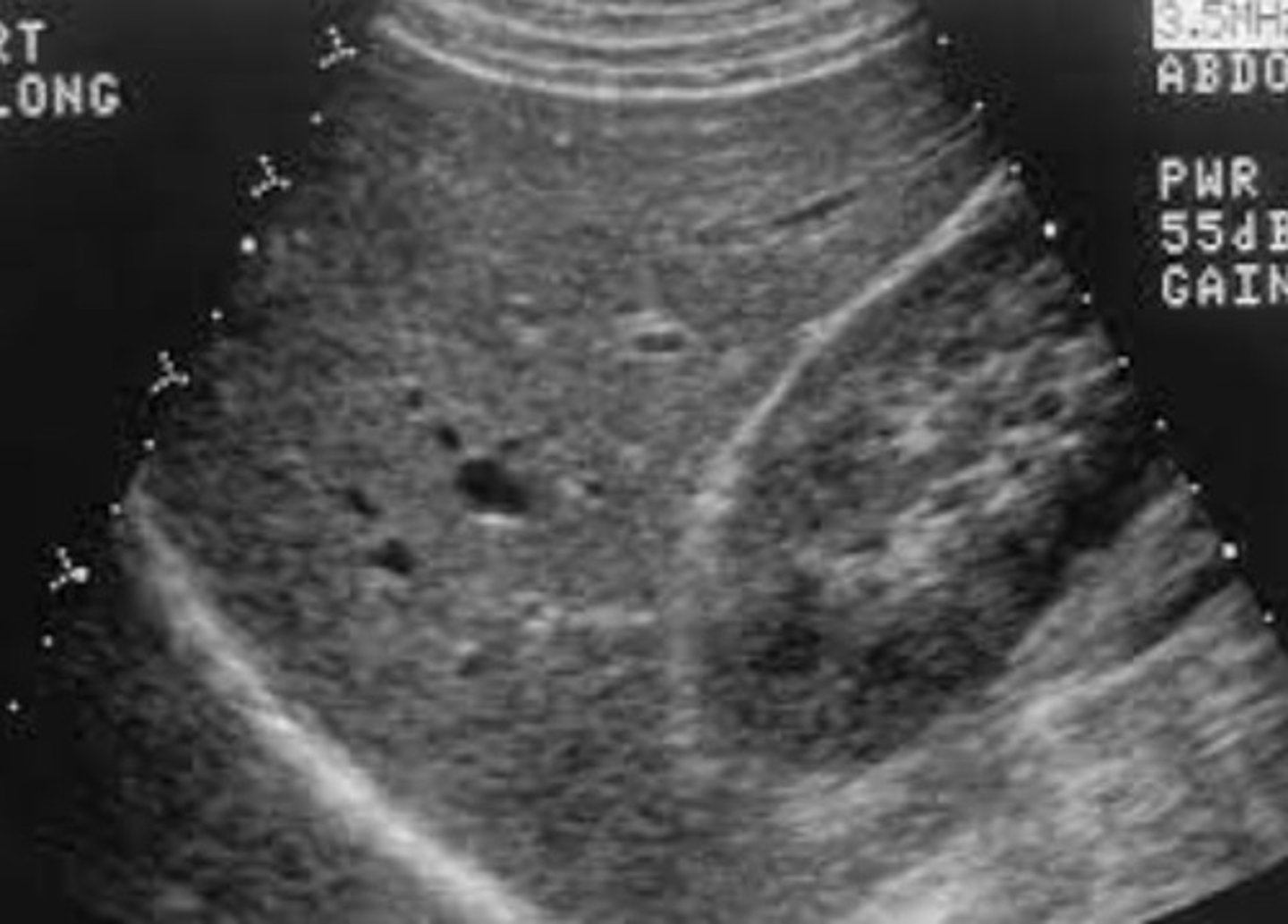 <p>Hyperechoic parenchyma</p><p>Decreased liver size</p><p>Granular and course texture</p>