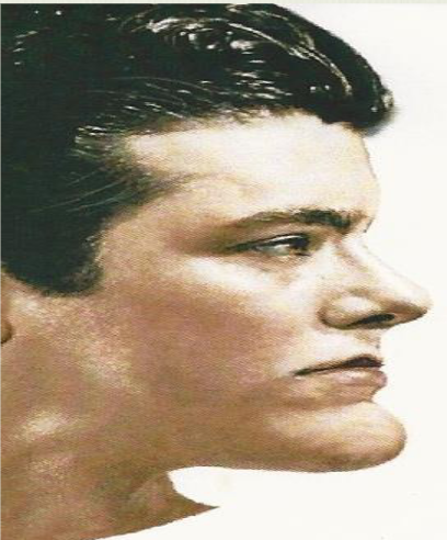 <p><span>Straight forehead; Protruding Chin</span></p>