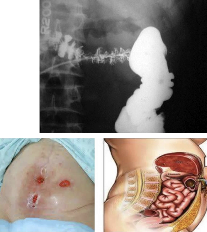<p><strong>abnormal connection of GI tract to skin</strong></p><p><em>Causes:</em><br>• Anastomotic leak<br>• Trauma/injury to the bowel/colon<br>• Crohn’s disease<br>• Diverticulitis<br>• Inflammation/infection </p><p>Dx: <strong>CT scan </strong>to r/o infection/abscess, fistulogram</p><p>Tx: <strong>NPO</strong>, nutrition (TPN), drain abscess, <strong>surgical operation and resection</strong></p><p><em>Complications: </em>high-output, malnutrition, skin breakdown</p>