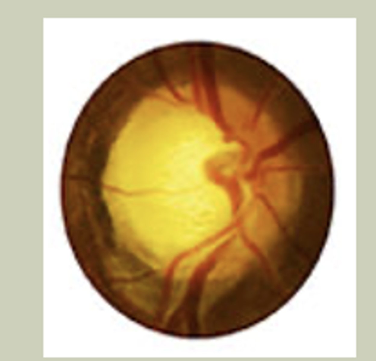 <p>-Gradual painless change to vision</p><p>-Unilateral or Bilateral</p><p>-Hx of being on glaucoma eye drops/surgies</p><p>-Will see large cup-to-disc ration on DO</p><p>-TX: Urgent referral to ECP</p>