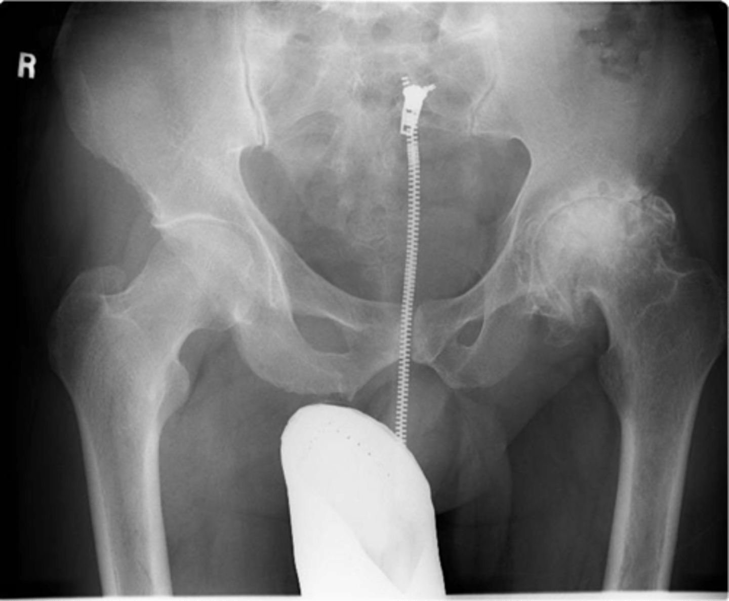 <p>A _____ correlation exists among the extent of radiologic changes and clinical signs and symptoms of degenerative joint disease</p>