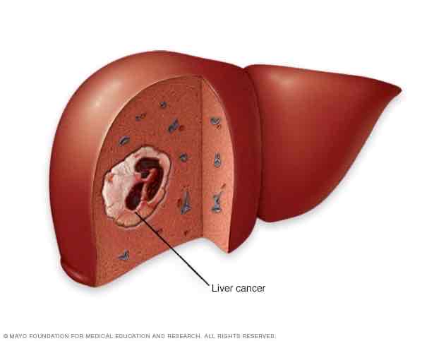 <p>Tumor of the liver</p>