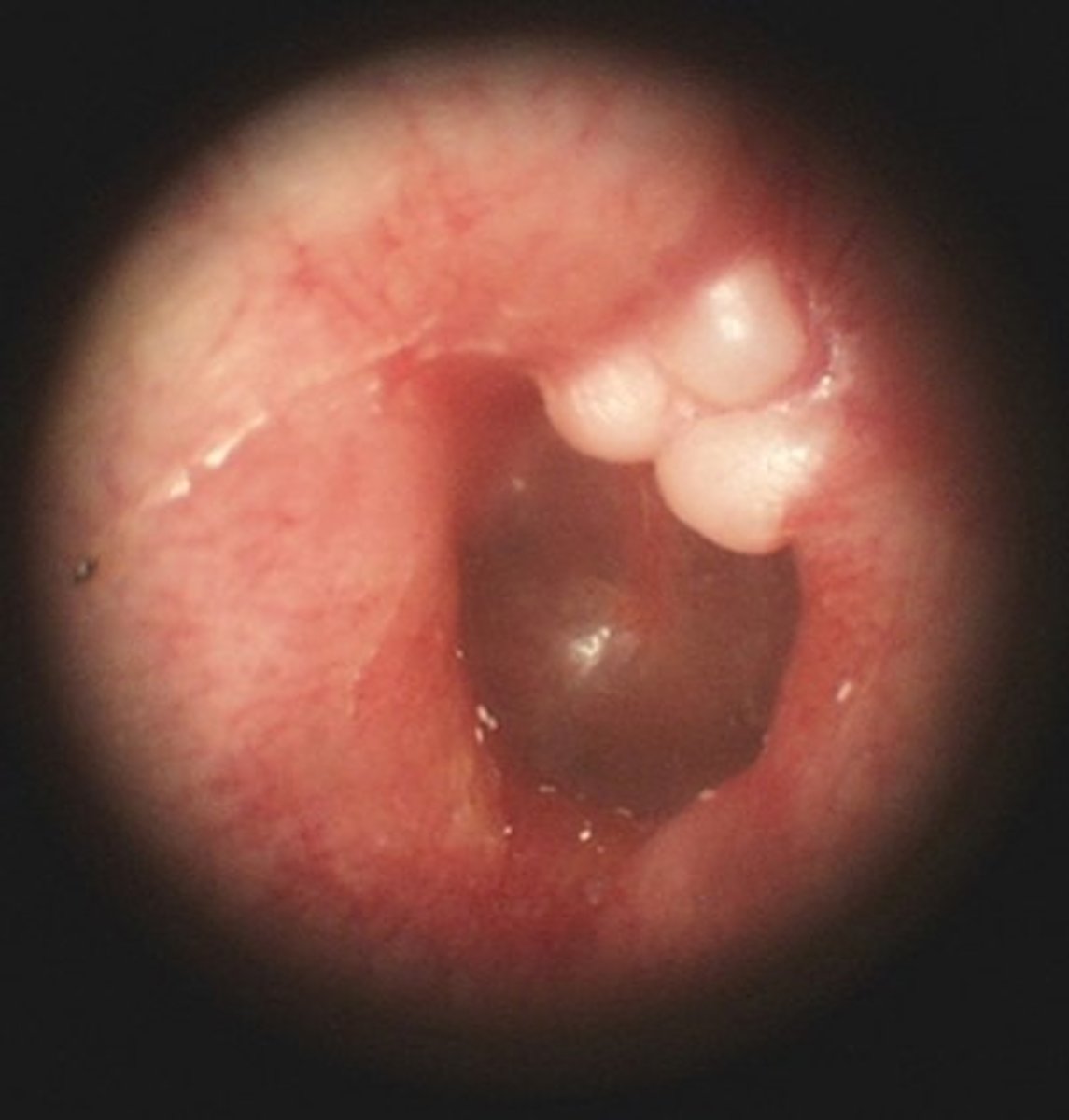 <p>Hard round outcroppings</p><p>Along auditory meatus</p><p>Multiple - usually bilateral</p><p>Slow growing</p><p>Asymptomatic - rare to occlude meatus</p><p>Risk factors:</p><p>Bony external canal stimulation with cold water</p>