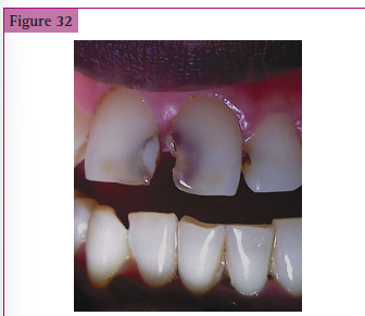 <p>__________ discoloration in the proximal aspect of the tooth indicative of _____________</p>