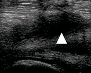 <p>semimembranosus bursa behind knee </p>