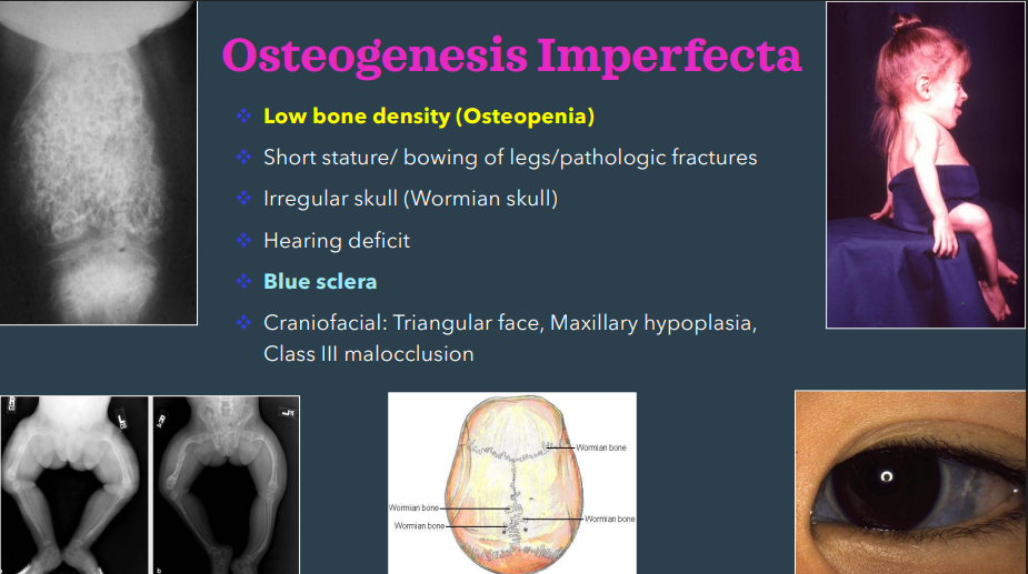<ul><li><p>low bone density- osteopenia </p></li><li><p>blue sclera </p></li></ul><p></p>