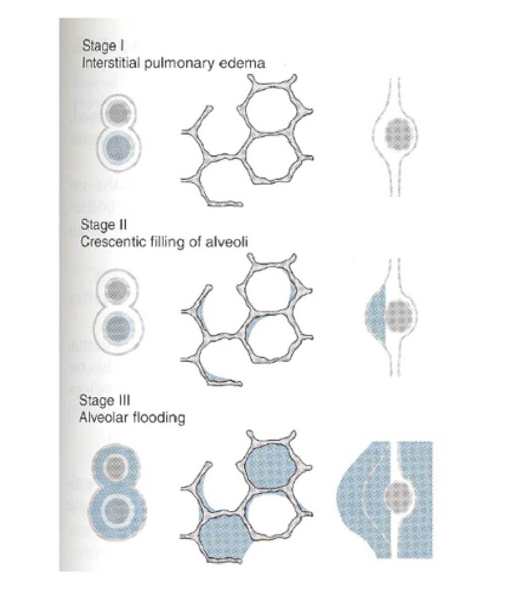 <p>flooding of peri-capillary interstitial spaces --&gt; crescentic filling of alveoli --&gt; flooding of individual alveoli with loss of gas exchange</p>