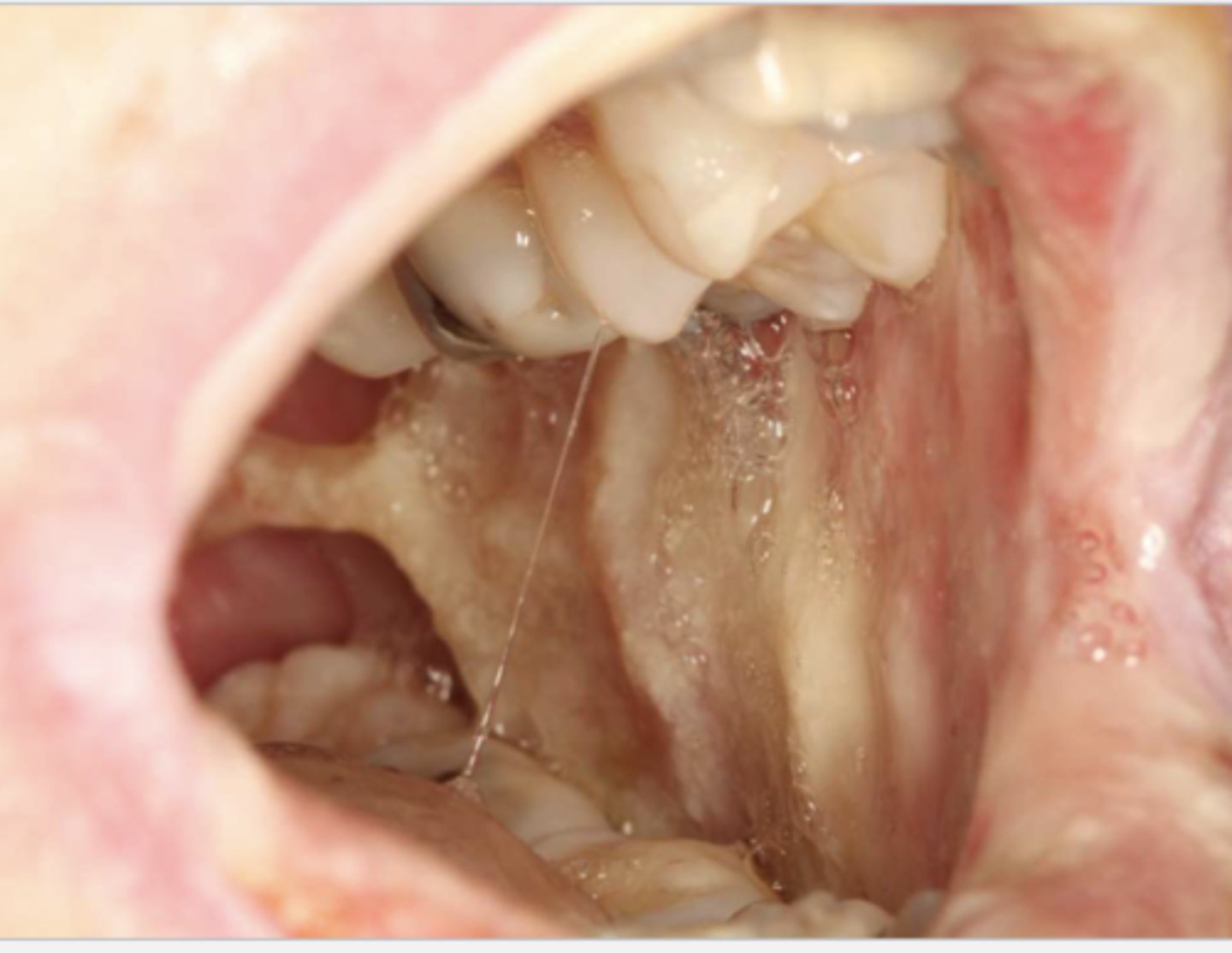 <p>Patient is currently undergoing chemotherapy for colon cancer. What do you suspect?</p>