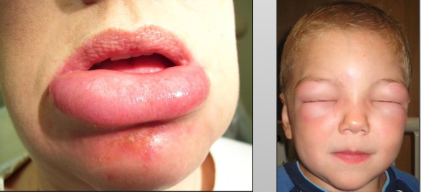 <p>Cervicofacial emphysema due to air in tissue</p>