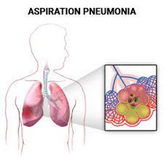<p>Aspiration (pneumonia)</p>