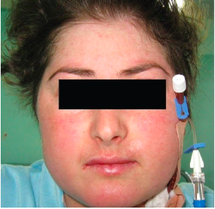 <p>moon face (corticosteroid-induced lipodystrophy)</p>