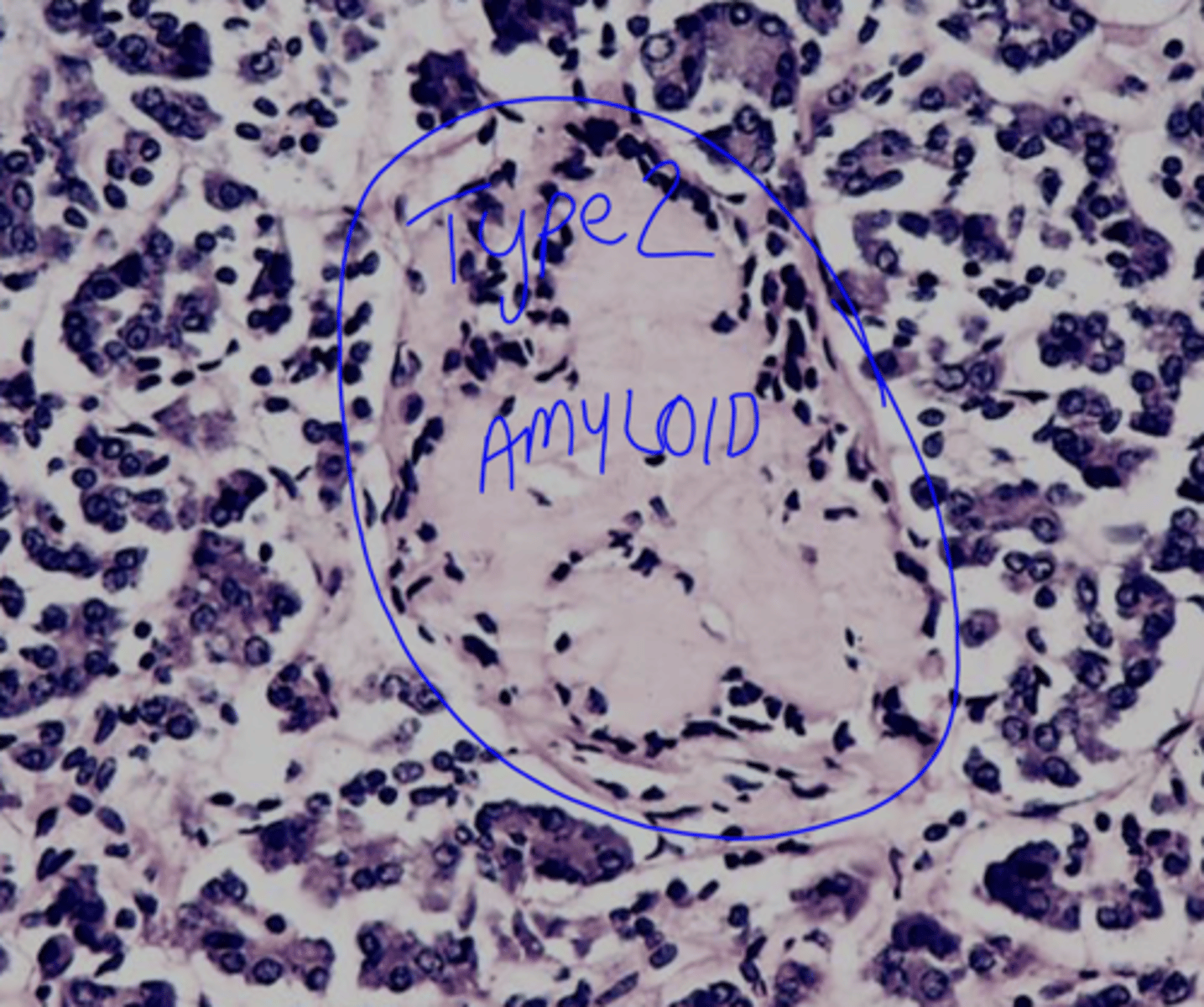 <p>amyloid deposits within islets</p>