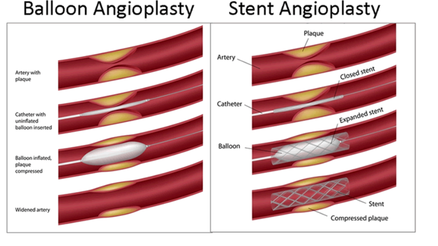 <p>what’s the difference between Angioplasty/Stent and a Bypass Graft</p>