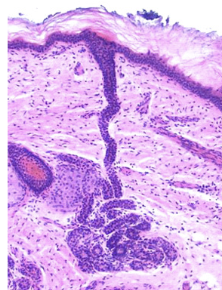 <p><strong>Eccrine v. Apocrine sweat glands</strong></p>