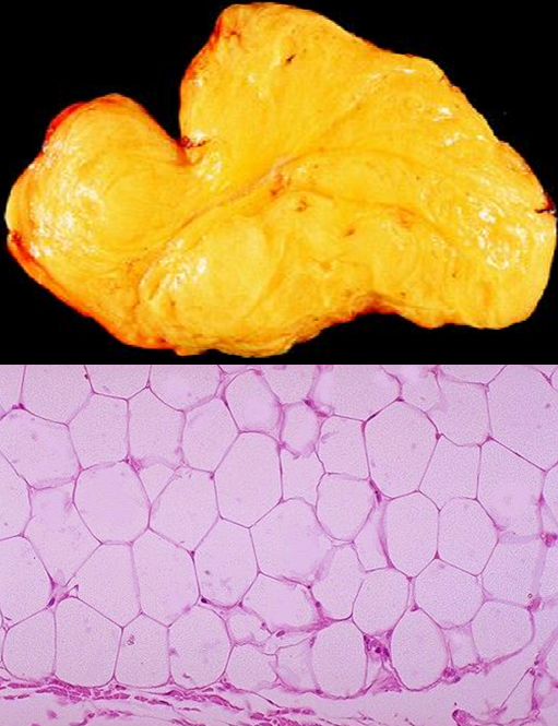 <p>most frequent soft tissue tumor, usually <strong><span style="color: red">arising in the subcutis of the proximal extremities &amp; trunk</span></strong> </p><p>clinical presentation</p><ul><li><p>during <strong><mark data-color="green">middle adulthood</mark></strong></p></li><li><p><strong><mark data-color="blue">superficial lesion which is well-circumscribed &amp; partially encapsulated</mark></strong></p></li><li><p>soft &amp; doughy to touch; rubbery &amp; moves easily when touched</p></li><li><p>histologically looks likes normal adipose tissue  </p></li></ul>