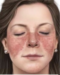 <p>what is systemic lupus erythematosus</p>