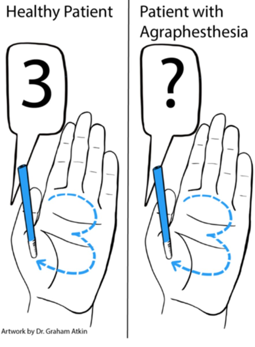 <p>inability to recognize symbols, letters or numbers traced on the skin</p>