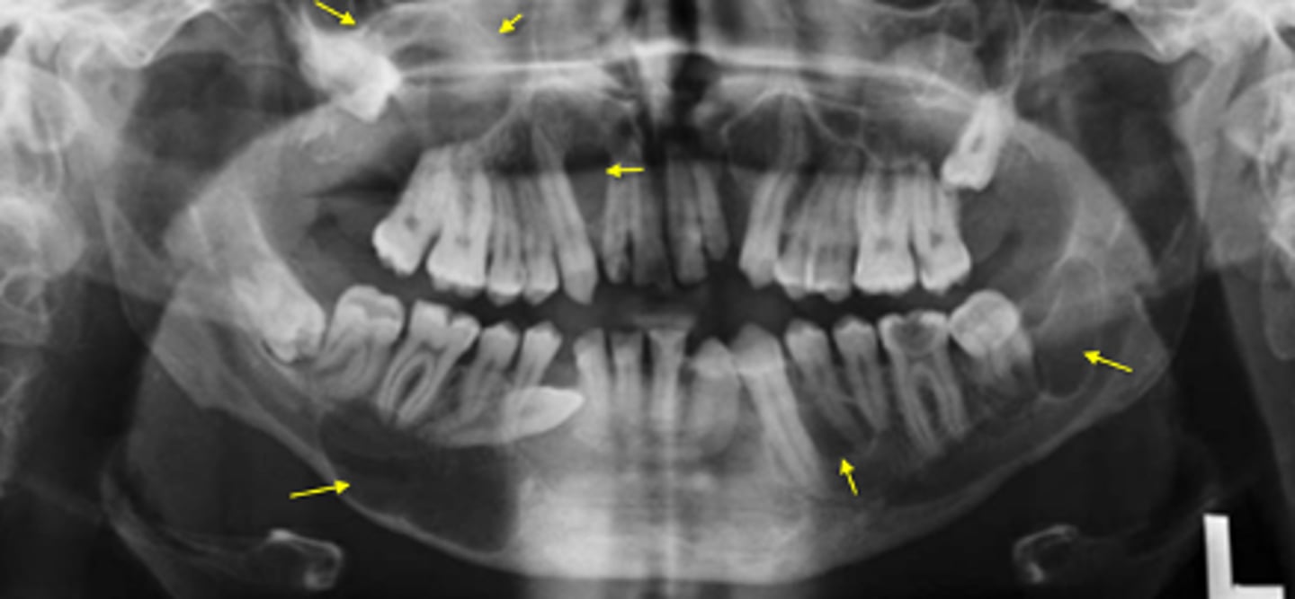 <p>ID the condition:</p><p>•Multiple OKCs/ KOTs in multiple locations of both jaws</p><p>•Other findings:</p><p>•Basal cell carcinoma</p><p>•Skeletal anomalies- bifid ribs</p><p>•Calcification of falx cerebri</p>