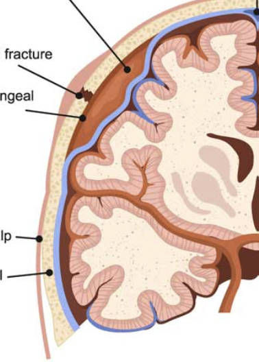 <p>bleed between dura and skull, usually middle meningeal a. bleed; rapid</p>