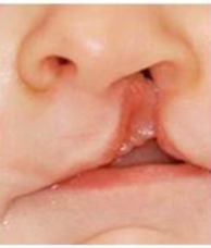 <p>cleft lip that extends into the nose </p>