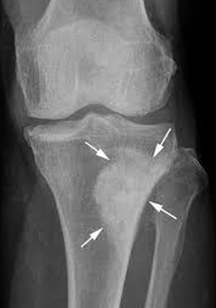 <p>What pathology is seen here?</p>