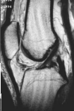 <p>door valgus stand en endorotatie onderbeen</p>
