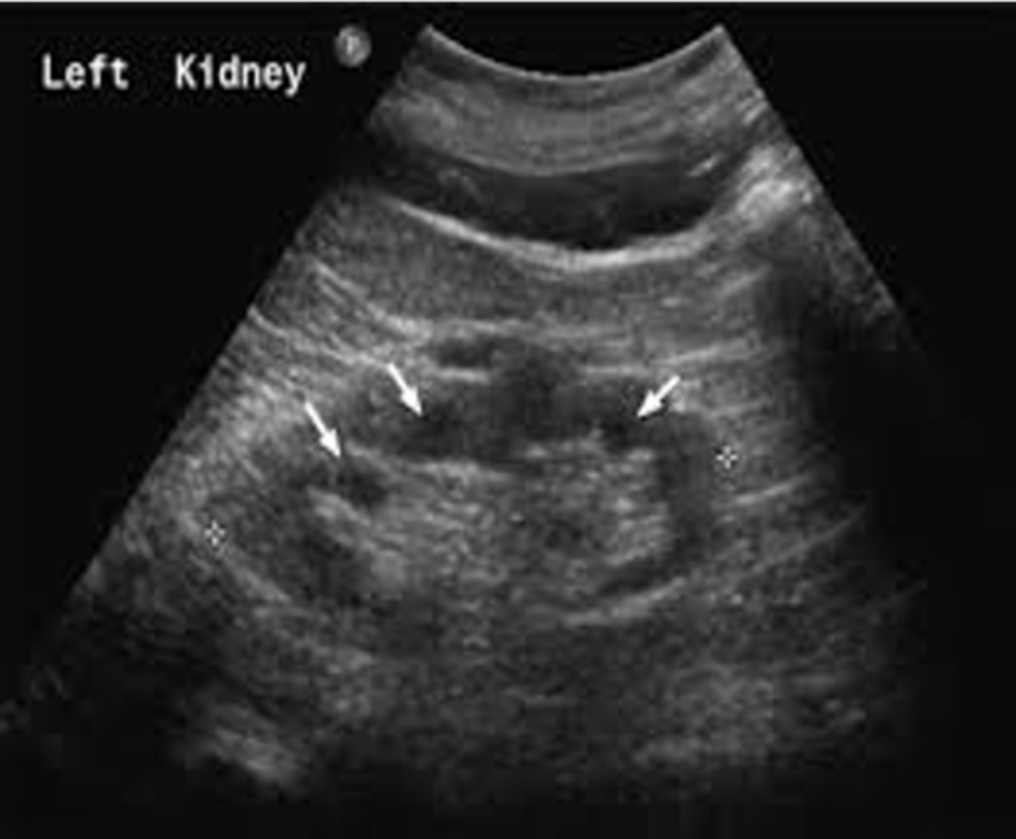 <p>Nephronophthisis (NPH) is autosomal ___ </p>