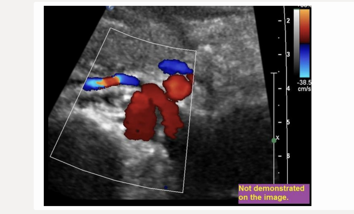 <p>find the left renal vein</p><p>.</p><p>[left renal vein = between SMA + AO]</p>