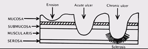 <p>not presisely known but many contibutary factors, excessive acid production or intrinsic defect in the mucosal barrier&nbsp;<br>gastric ulcers normally due to inflammatory response of parietal cells&nbsp;due to damage to underlying mucosa&nbsp;<br>duodenal ulcers normallt associated with high acid/low bicarbonate&nbsp;<br>infection with <em>H. Pylori</em><br>long term use of NSAIDs as block COX enzymes decreasing prostaglandn production&nbsp;<br>errosion eventually reaches the muscularis layer, gastric pain is triggered due to the nerve complexes underneath, if not treated this leads to a chronic ulcer which can perferate the gastric system and can be life threatening</p>