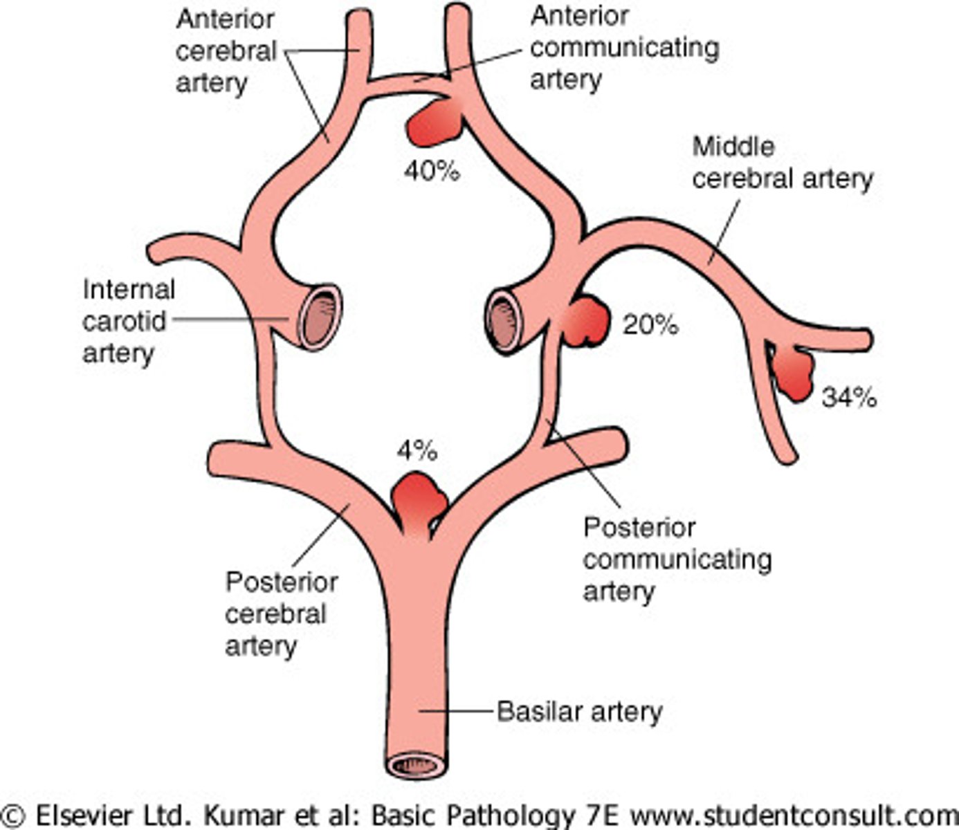 <p>rupture of a berry aneurysm around the circle of Willis</p>