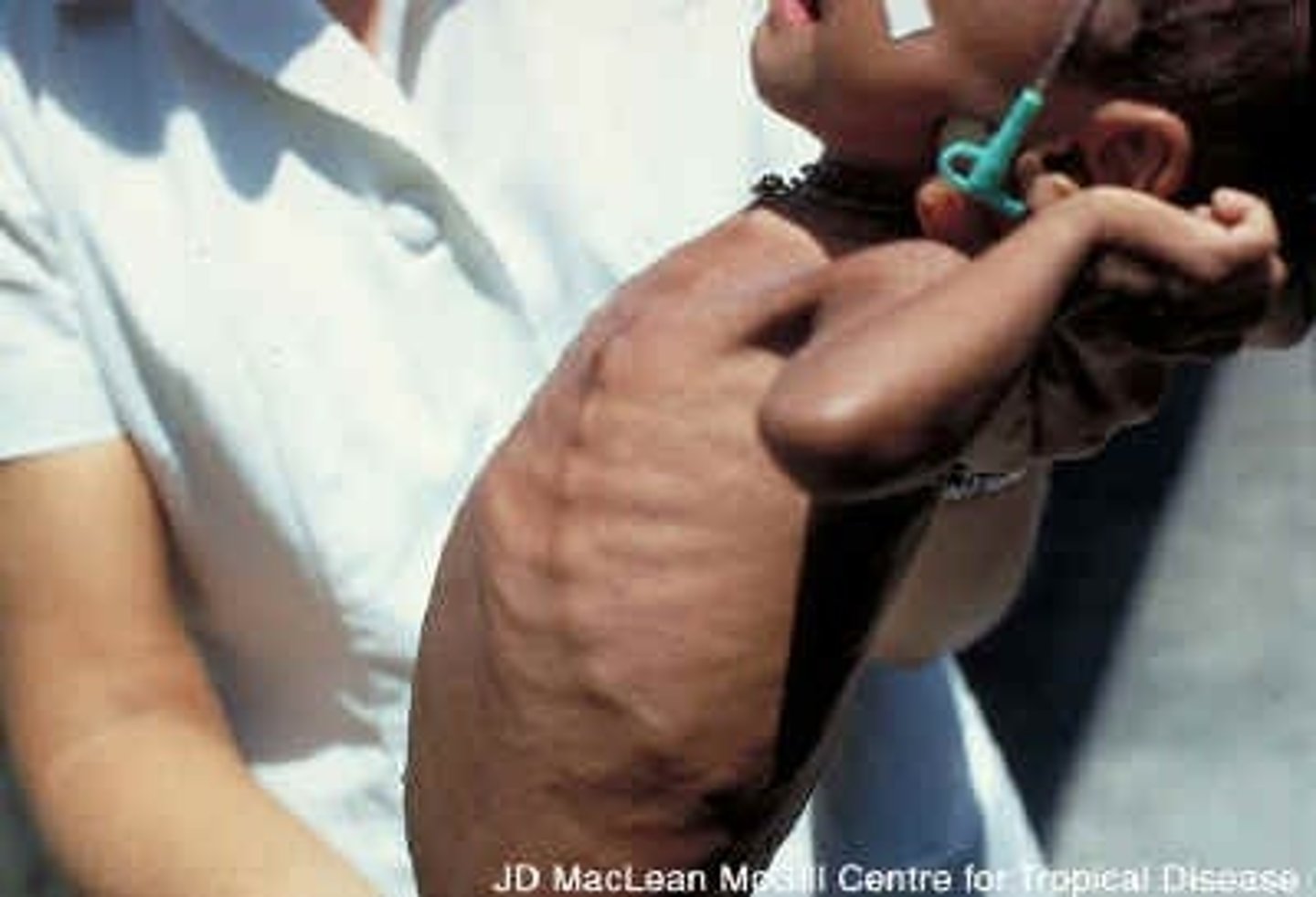 <p>Long bones become soft and deformed (bowing of legs)</p><p>Frontal bone bossing, enlargement of costochondral junctions of the ribs (rachitic or rickety rosary)</p>