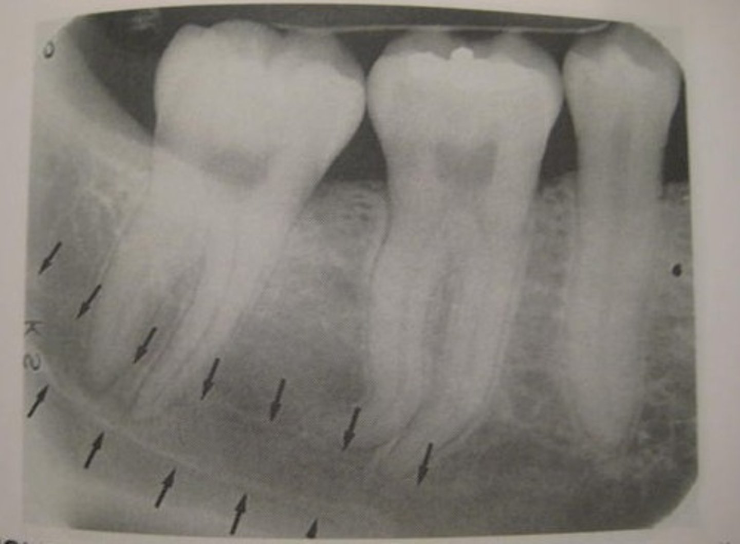 <p>Radiolucent band with radiopaque borders below mandibular molars</p>