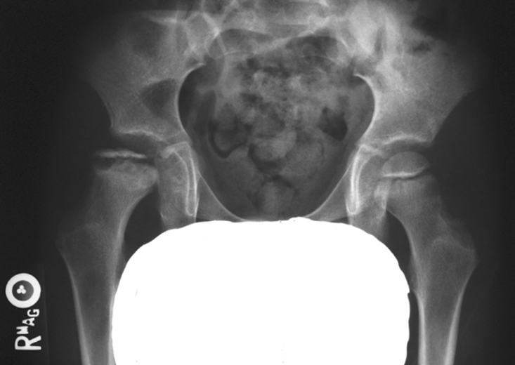 <p>↓ size, flattened femoral head, ↑ density of epiphysis, widened neck, enlarged GT, low MRI signal.</p>