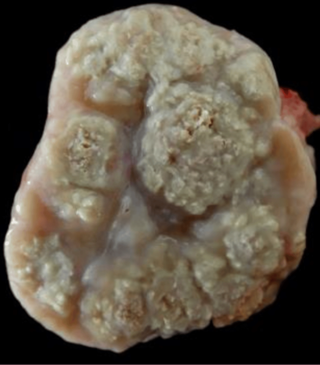 <p>describe what extracellular accumulation you would expect to see with this lesion</p>