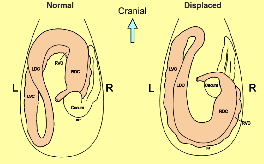 <p>right dorsal displacement</p>