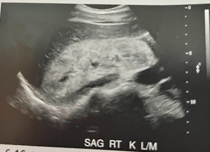 <p>A 25 year old man was admitted after a serious automobile accident has a portable renal US performed in the ICU. He is recovering from a surgery repair for a fractured pelvis and femur. The pt has remained hypotensive w/decreased urine output despite being given fluid and medications. The renal sonogram reveals appropriately sized but echogenic kidneys bilaterally. What is the likely diagnosis for this pt?</p>