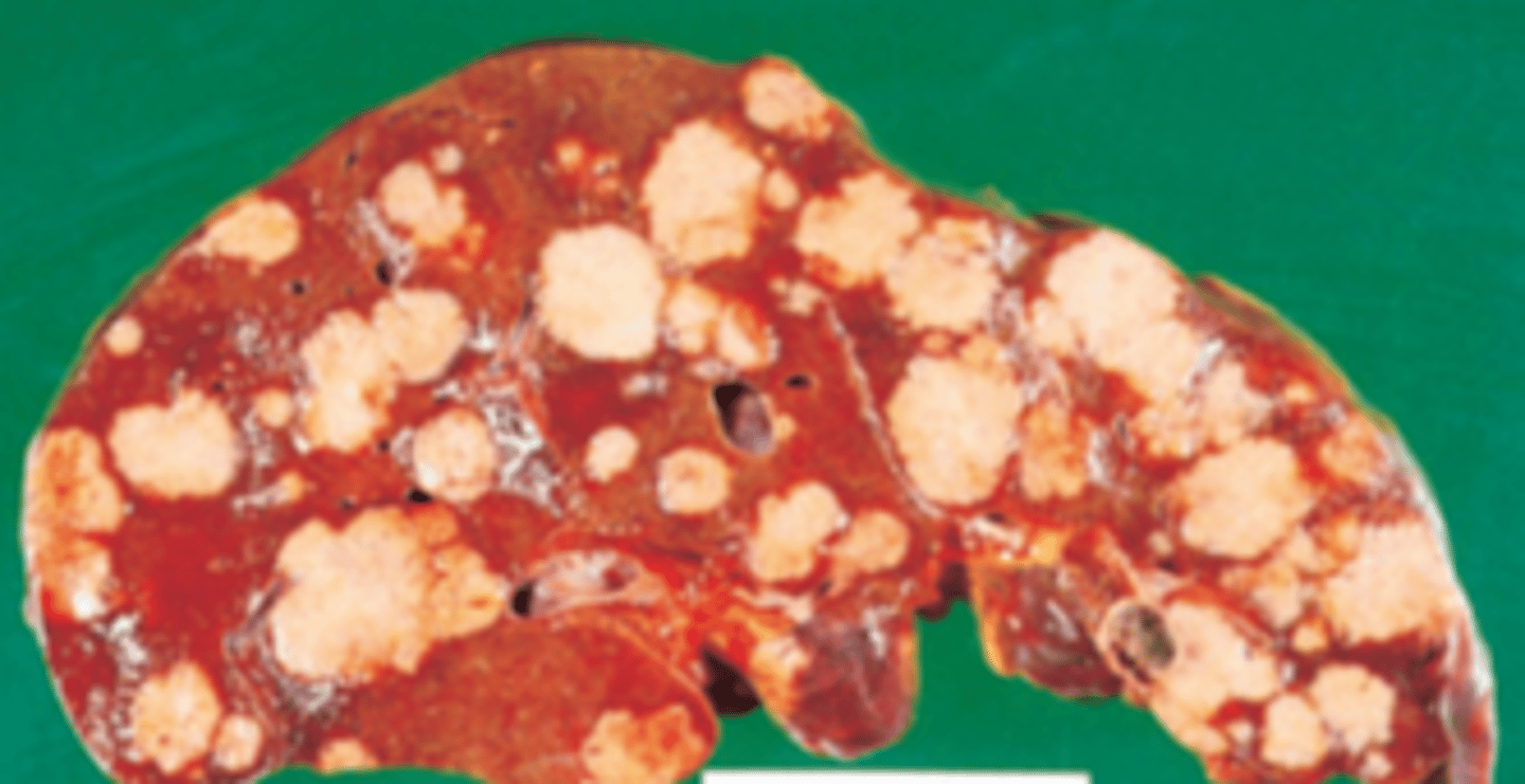 <p>A 69-year-old woman arrives in the emergency room complaining of weakness, abdominal pain, and a 9 kg (20 lb) weight loss during the past month. Physical examination reveals jaundice, conspicuous hepatomegaly, and ascites. The patient expires, and a section of liver is examined at autopsy (shown in the image). Which of the following is the most likely diagnosis?</p><p>(A) Hemangiosarcoma of the liver</p><p>(B) Metastatic carcinoma of the liver</p><p>(C) Miliary tuberculosis</p><p>(D) Primary hepatocellular carcinoma</p><p>(E) Sarcoidosis</p>