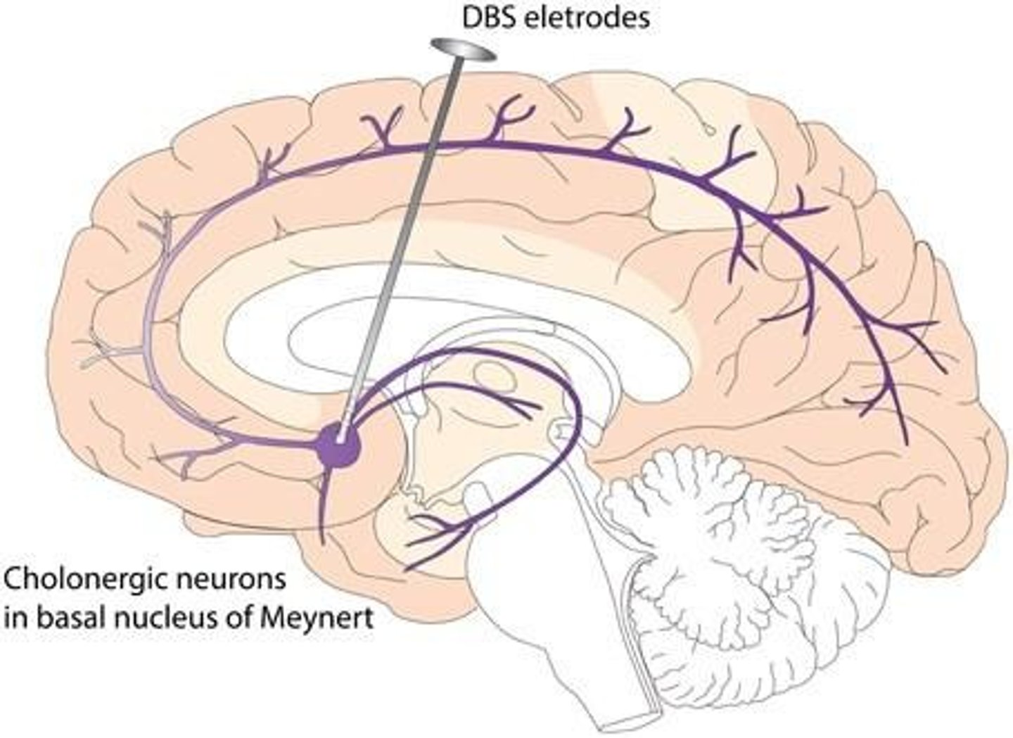 <p>- Implanter une électrode directement dans une région spécifique du cerveau. Cette électrode est reliée à un générateur d'impulsions placé sous la peau, généralement au niveau de la poitrine.</p><p>- Traite les troubles neurologiques sévères en modulant l'activité neuronale</p><p>- Réversible et ajustable</p><p>- Ex : électrodes dans les ganglions de la base pour Parkinson</p>