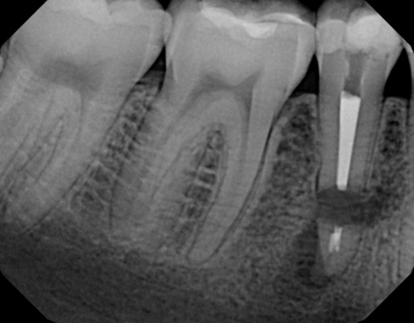 <p>What anatomical structure is interfering with the ability to do surgery?</p>
