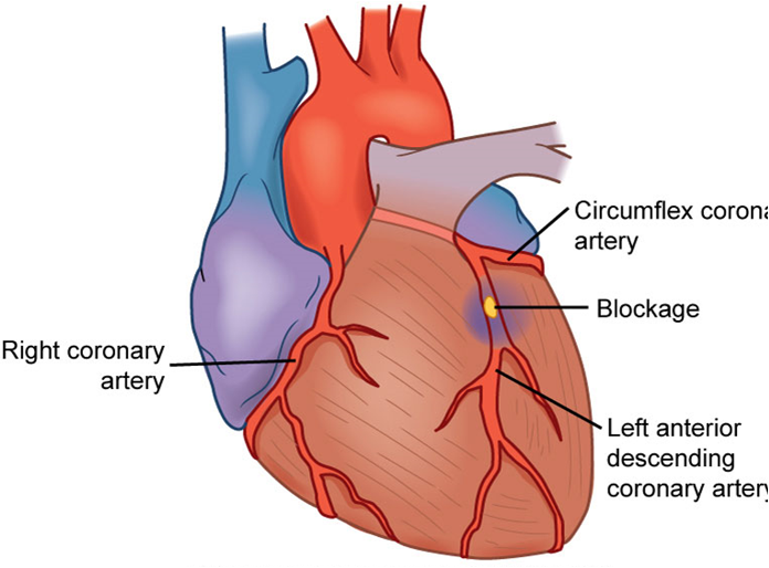<p>A medical emergency caused by a sudden decrease in blood flow to the heart muscle</p>