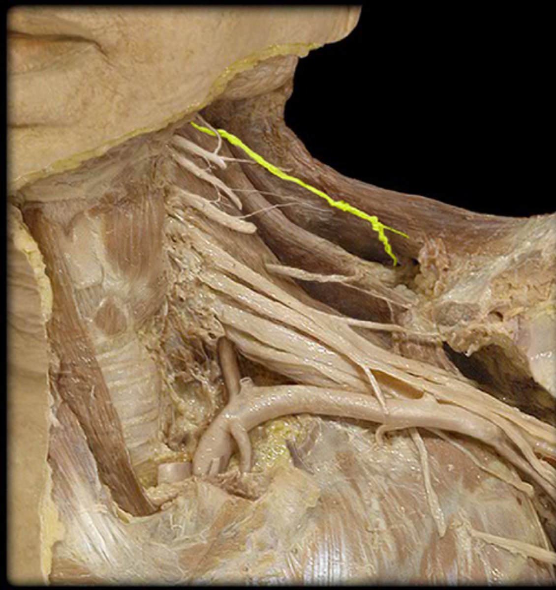 <p>trapezius innervation, find it running deep to the trapezius m, runs with transverse cervical artery</p>