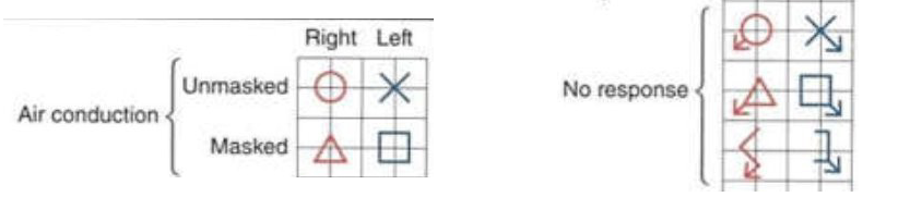 <p>Left ear: blue X</p><p>Right ear: red O</p><p>Symbol placed at the intersection of frequency and intensity that represents the threshold</p>