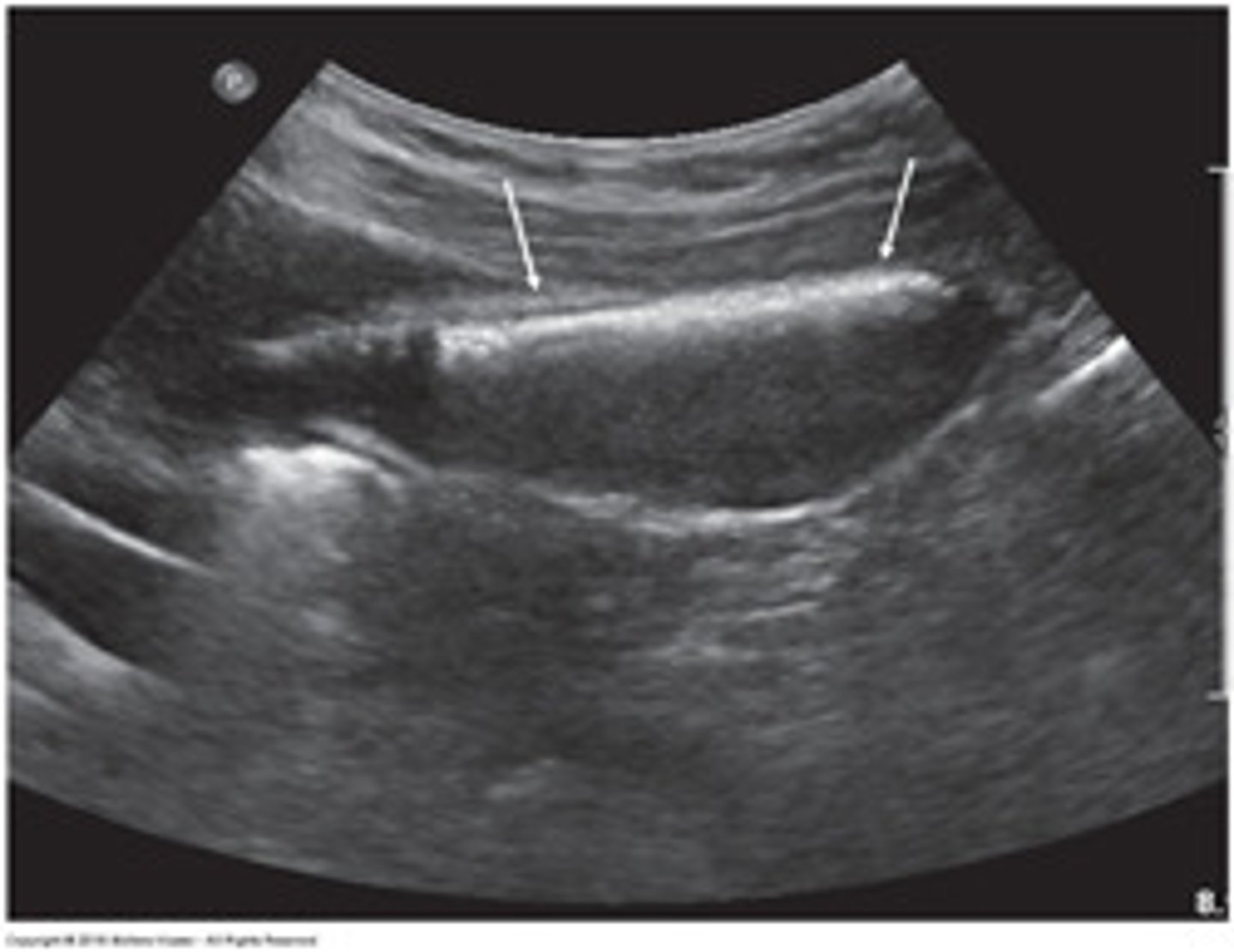 <p>- Bright echo along anterior GB wall</p><p>-gas bubbles in the wall that cause dirty shadowing, reverberation, or ring-down artifact</p><p>-bubbles will rise to the non-dependent wall, causing the champagne sign</p><p>-WES sign if large amount of gas is present</p>