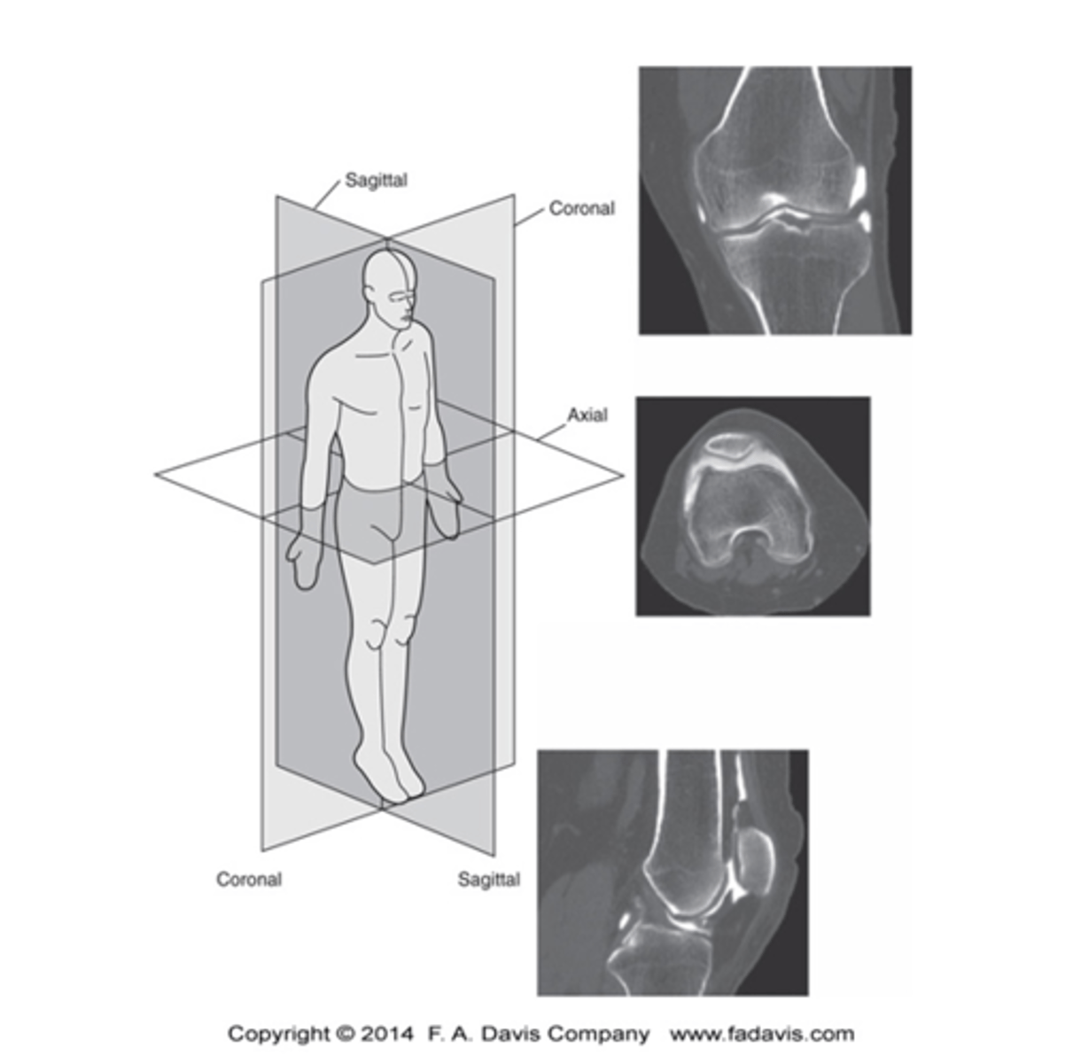 <p>Each pixel is assigned a shade of gray to correlate with the radiodensity of the cubic volume of the tissue it represents</p>