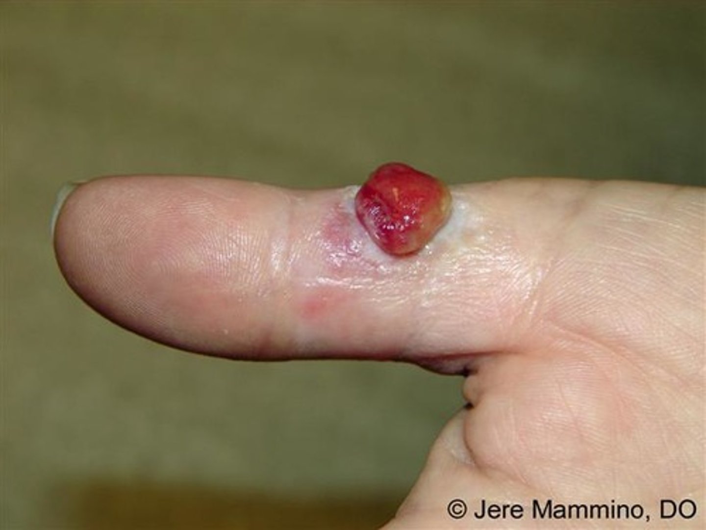 <p>-benign vascular lesion of skin and mucosa, rapidly growing</p><p>-a <strong>glistening, friable, bright red papule or nodule that bleeds spontaneously or after trauma</strong></p><p>-unknown cause</p><p>-not infectious or granulomatous</p><p>-most often on hand, neck, extremities, trunk, but can also arise on the gingiva or oral mucosa</p><p><strong>-can arise in pregnancy</strong></p>