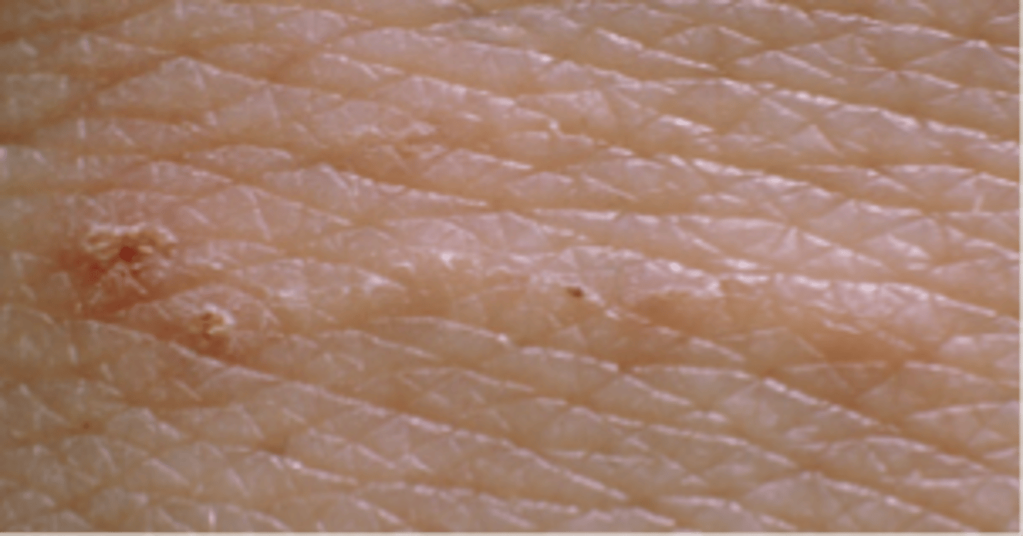 <p>name this skin pathology</p>