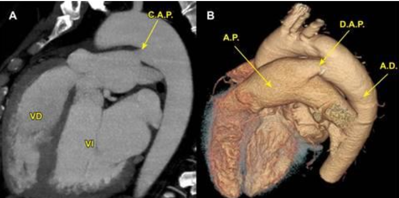 <p>Diagnóstico: disnea de esfuerzo, taquipnea, soplo continuo.</p><p>Imagen: Tomografía computarizada (A), volumen 3D por tomografía</p>